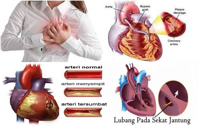  Cara Mengpbati Jantung Bocor Terbukti SEMBUH Tanpa Operasi 