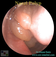 Nasal Polyp - Definition, Symptoms, Diagnosis and Treatment