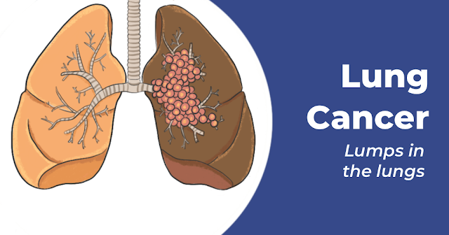 Understanding Lung Cancer Symptoms and Its types