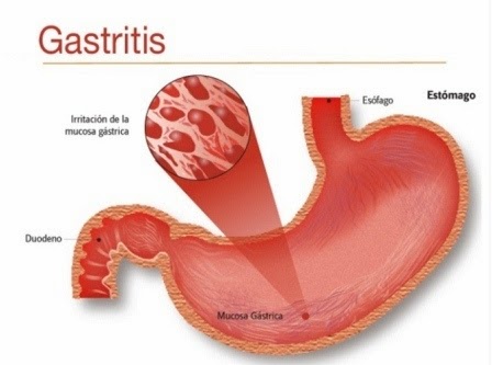 Let s Go Public Health Gastritis 