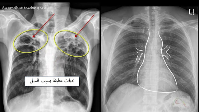 آشعة عادية على الصدر (X-ray) لمريض السل في الرئة وتفريقها عن الطبيعي