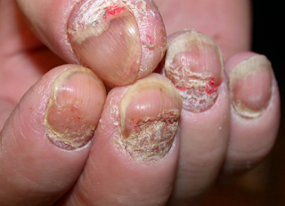 psoriasis kuku