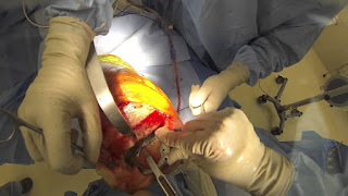 knee transplant sugery