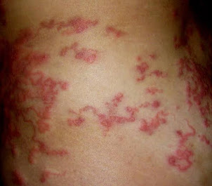 Pharmacotherapy of cutaneous Larva Migrans