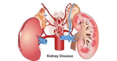 Kidney Disease:परिभाषा, प्रकार, लक्षण, कारण व रोकथाम