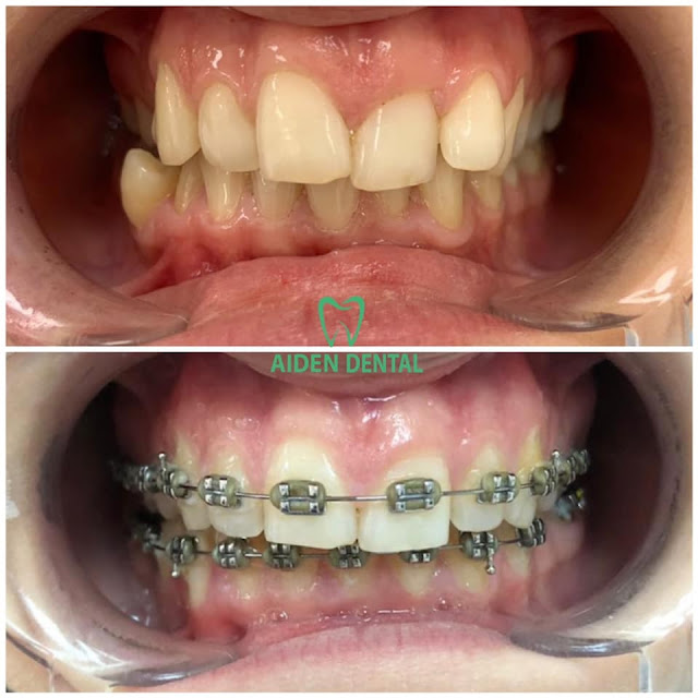 Il risultato finora dopo il trattamento ortodontico!