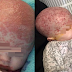 Six-month-old baby infected with herpes disease from a kiss
