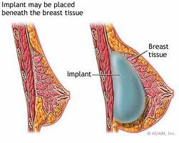 K Breast Filler เสริมหน้าอกเทคนิคเกาหลี ไม่ต้องผ่าตัด