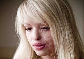 Katie Piper Face After the Accident