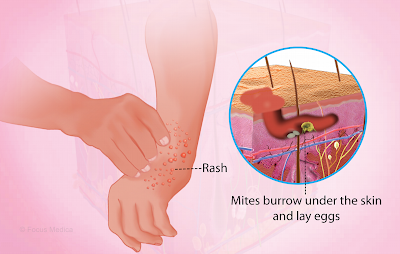 best home remedies for Scabies