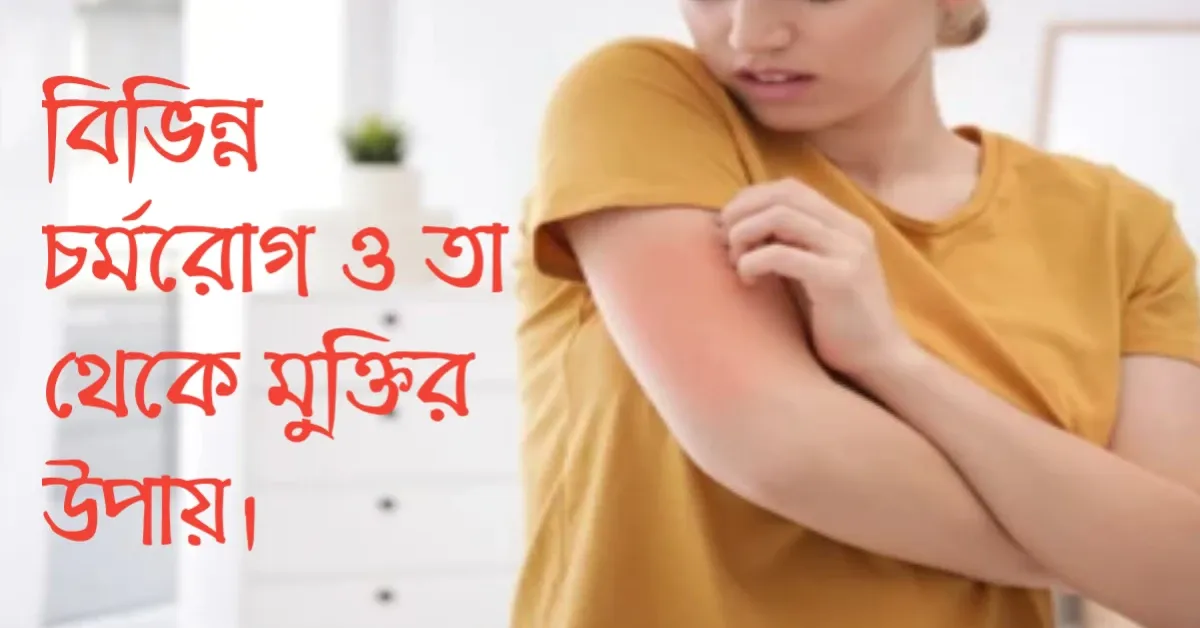 চর্মরোগ থেকে মুক্তির উপায়