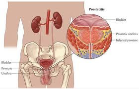 prostatitis cronica sintomas prostatitis cronica
