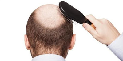 Cara Mudah Mencegah dan Mengatasi Kebotakan Rambut