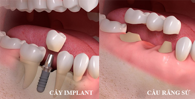 Chi phí cấy ghép răng implant bao nhiêu?