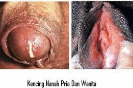 Penis Bernanah Dan Bagaimana Cara Mengobatinya?