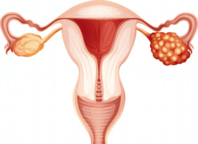 ovarian-cancer-prognosis-life-expectancy