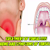 Treatment of tonsillitis at home and symptoms of tonsillitis