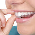  Niềng răng không mắc cài thẩm mỹ giá bao nhiêu?