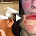 How To Use Ice On Acne Skin And Remove Acne Within 24 Hours