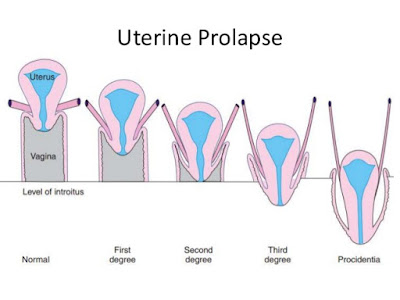 Uterus Prolapse