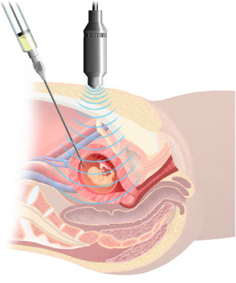 Amniocentesis Needles