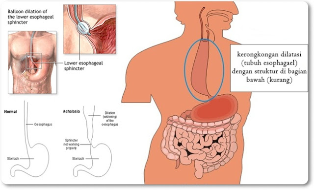 Obat Akalasia Herbal