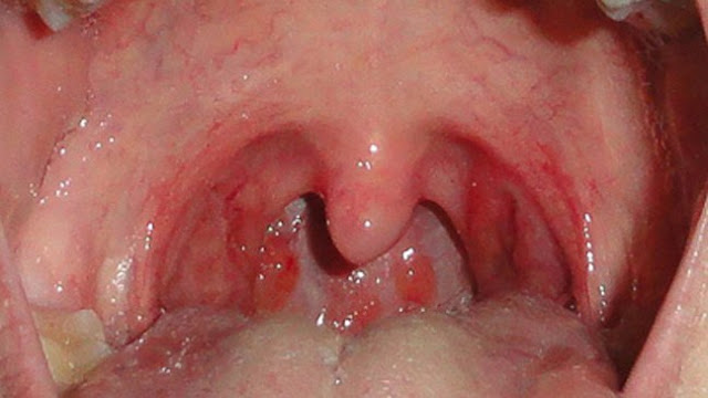 throat-cancer-from-oral-sex