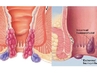 Mengobati Wasir Yang Bengkak
