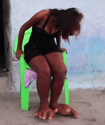 elephantiasis, Brazilian woman's feet