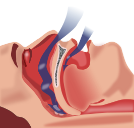 what is sleep apnea | sleep apnea treatment | obstructive sleep apnea | central sleep apnea