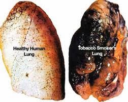 Mesothelioma Asbestos