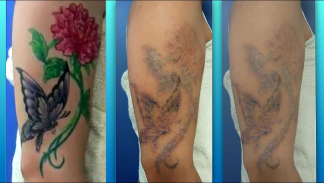 como-remover-tatuagem-naturalmente