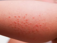 Cara Menghilangkan Bintik Merah Akibat Gigitan Nyamuk
