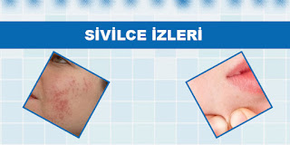 Sivilce İzleri