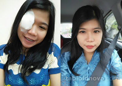 Akibat Keseringan Memakai Softlens