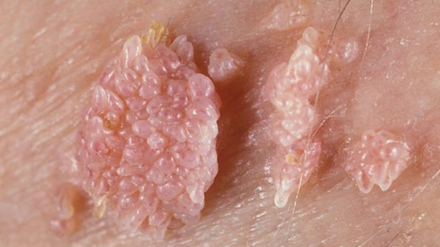 السنط التناسلي والثآليل genital warts