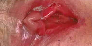 Vaginal Yeast Infection Pictures - 4