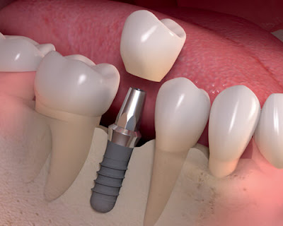 Lợi ích và hạn chế của trồng răng Implant