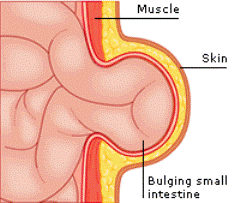 Hernia