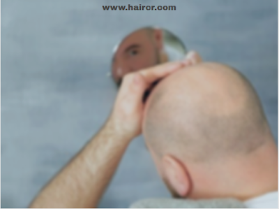 Causes of baldness and solutions to prevent it