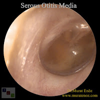 Serous Otitis Media