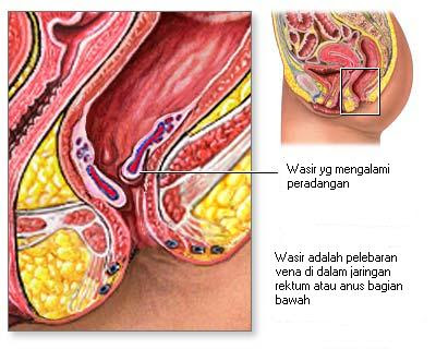 Hemoroid (Wasir/Ambeien)