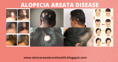 Alopecia Areata Disease