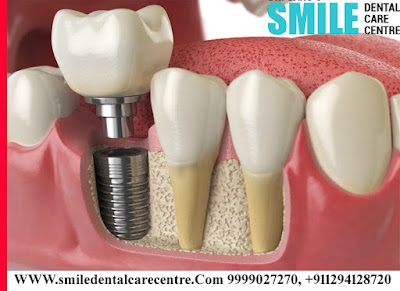 Best Dental Implant Clinic in Faridabad