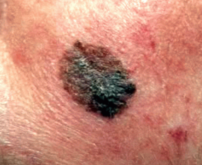 Skin Cancer