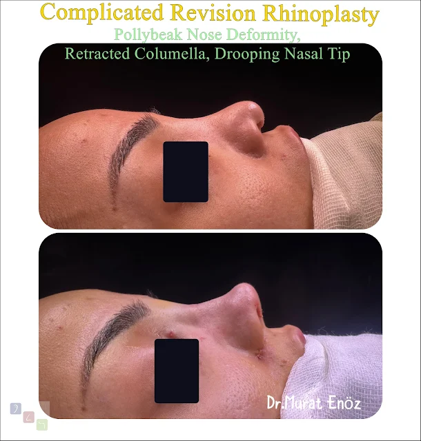 Complicated Revision Rhinoplasty - Pollybeak Nasal Deformity, Retracted Columella, Drooping Nasal Tip - Bilevel skin dissection and underskin tissue removal