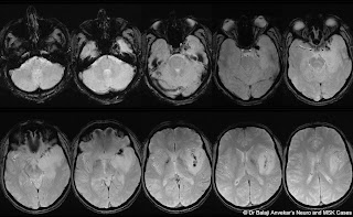 THROMBOSIS%2BPARASELLAR%2BPETROUSAL%2BSI