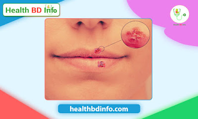 জ্বর ঠোসা ( Cold Sore) কি  কেন হয় এবং সারানোর উপায়