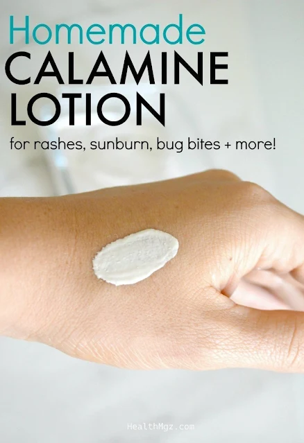 DIY Calamine Lotion To Soothe Bug Bites & Itchy Rashes