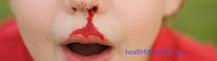 Inherited Bleeding Disorder-Hemophilia